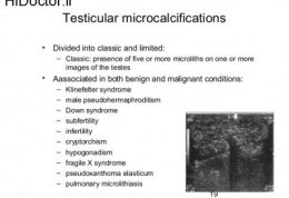 مطالبی مهم درمورد میکروکلسیفیکاسیون در بیضه