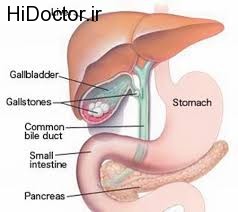 عارضه سنگ کیسه صفرا و خلاصی از آن