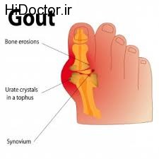 علائم بارز درعارضه نقرس