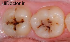 درد ناشی از کرم خوردگی دندان و پوسیدگی آن