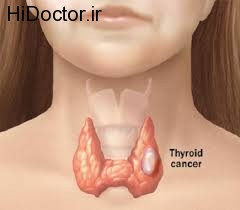 درمان های مختلف برای سرطان در غدد تیروئید