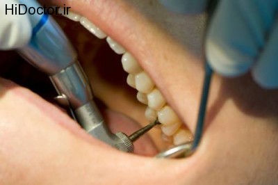 رفع ناراحتی ها پس از ترمیم دندان