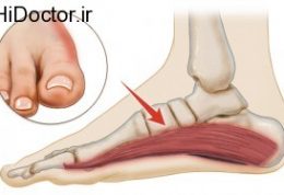 علت مهم گرفتگی در کف پا چیست؟