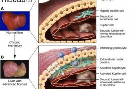فیبروز کبدی با تشدید چرب بودن کبد