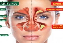 کنترل سینوزیت با این روش های ساده