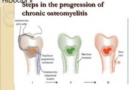 مشکلات رایج یک بیمار مبتلا به استئومیلیت