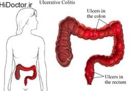 ارتباط کولیت روده با استرس