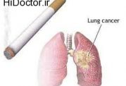 هشدارهای مهم برای سرطان در ریه