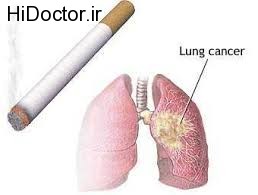 هشدارهای مهم برای سرطان در ریه