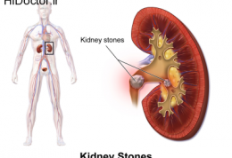 اصول و روش پیشگیری از تولید سنگ کلیه