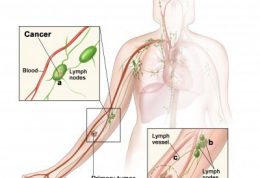 سرطان در غدد لنفاوی و این عوامل