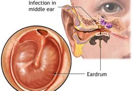 اوتیت مزمن میانی Chronic otitis media