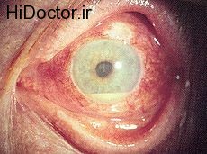 منظور از یووئیت  Uveitis چیست