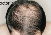 ریزش موی ناشی از کمبود آهن بدن