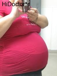اثرات منفی چربی شکمی بر دیابت بارداری