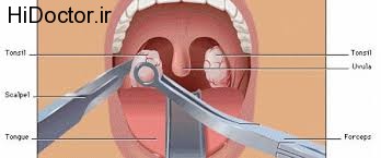 اطلاعاتی مفید در زمینه تانسیلکتومی