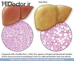 روش های درمانی متفاوت برای کبد چرب