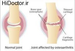آرتروز و آسیب های مختلف آن روی مردان و زنان