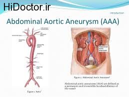اختلالات مربوط به آئورت شکمی و این درمان ها