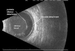 بررسی چشم با اولتراسونوگرافی