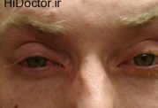 کونژنکتیویت (التهاب ملتحمه چشم) Conjunctivities