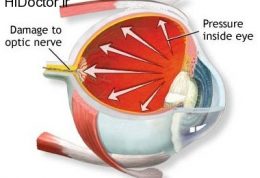 مایع زلالیه و فشار داخل چشمی