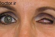 اقدامات پرستاری برای تخلیه چشم