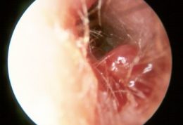 اوتیت بدخیم گوش خارجی Malignant External otitis