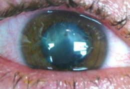 فرو رفتن جسم خارجی در داخل چشم (IOFB)