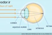 عیوب انکساری چشم و کاهش دید