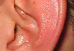 توده های گوش خارجی Mensses of Exernal Ear