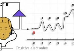 واکنش شنوایی ساقه مغز Auditory Brain Stem Response
