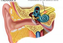 نورنیت دهلیزی Vestibular neuronitis