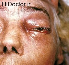 موکور میکوزیس (بیماری ناشی از عفونت خارجی) Mucormycosis
