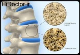 پیشگیری از پوک شدن استخوان ها در زنان خانه دار