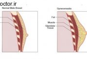 انواع اختلالات مربوط به سینه مردان