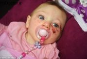تولد نوزادی با اختلال نادر مغزی