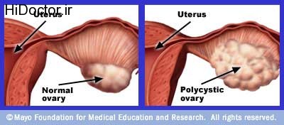 بیماری های مربوط به کیست تخمدان