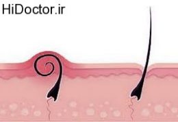 چاره زیرپوستی شدن موهای بدن