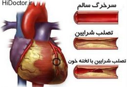 تصلب شرایین و پیشگیری از بروز آن