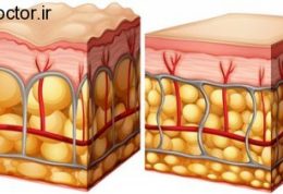 چگونه از شر سلولیت در امان بمانیم