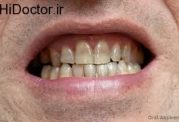 عوارض و آسیب های مشکل ساز برای دندان ها