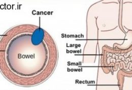 بیمارشدن روده بزرگ