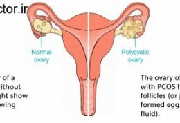 عارضه های نادر در تخمدان ها