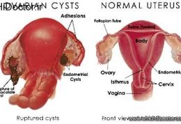 حواستان به تومورهای تخمدان باشید