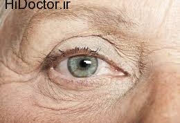 آنفارکتوس عصب بینایی (اپتیک)
