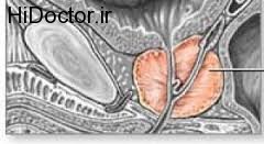 جایگاه داروها در درمان بزرگی خوش خیم پروستات