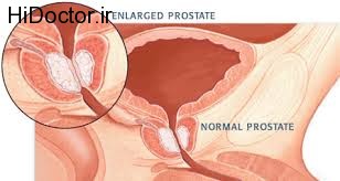 بزرگی خوش خیم پروستات یا BPH