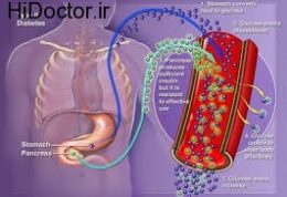 نحوه  کنترل دیابت نوع اول