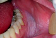 مشخص شدن سرطان دهان با این علائم
